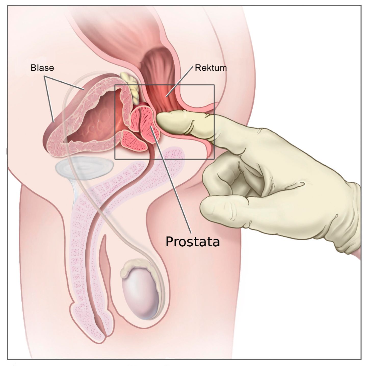 Anatomische Darstellung, wie der Finger eines Arztes die Prostata über den Enddarm (Rektum) abtastet.