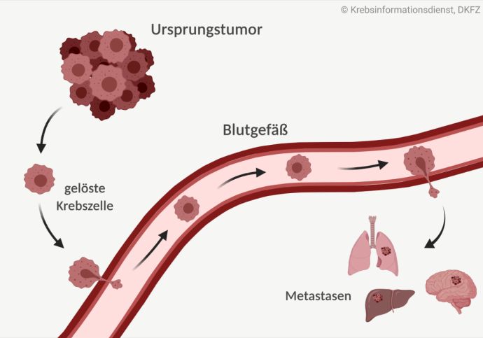 Vom Ursprungstumor lösen sich Krebszellen ab und gelangen über die Blutbahn in andere Organe. Dort bilden sie Metastasen.
